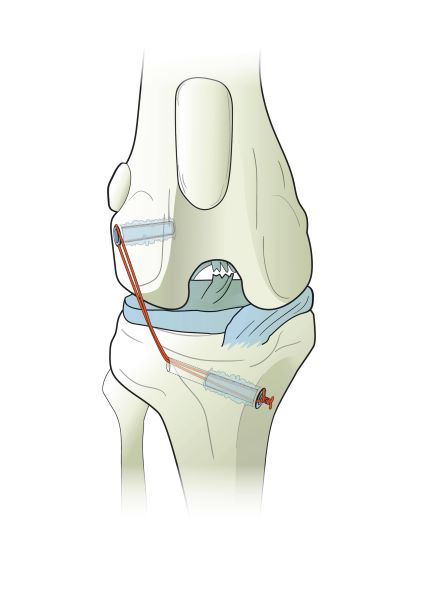  Ti-Force Full Thread Anchors käytettynä nivelten ligamenttien korjauksessa