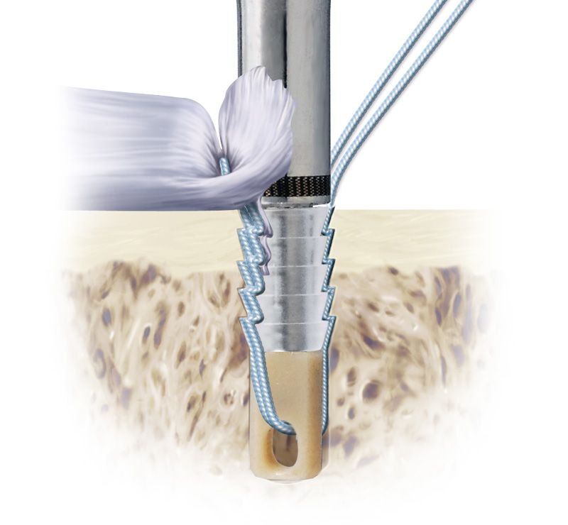  Bio-Force Soft Anchor kirurgisissa tilanteissa